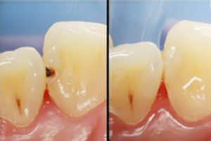 コンポジットレジンによる虫歯治療