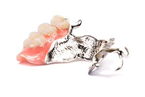 金属床義歯（入れ歯）
