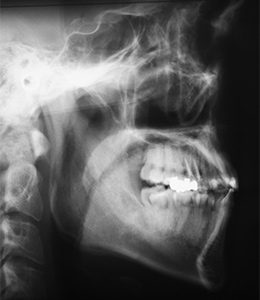 矯正歯科のセファログラム