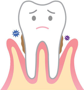 初期～中度の歯周病