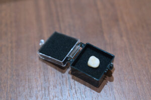 セラミックスの修復物