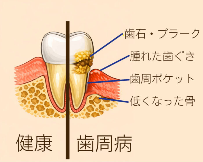 歯周病の病態の図示